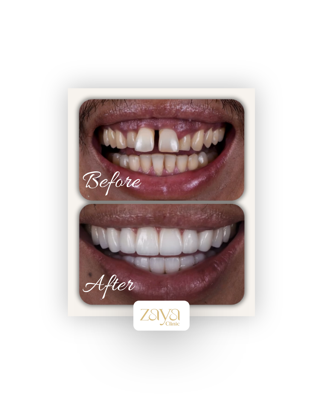 Before and after result at Zaya Clinic 2